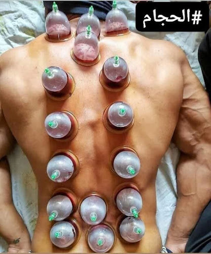 الحجامة_والطب النبوي أخصائي الحجامة أحمد ياسين